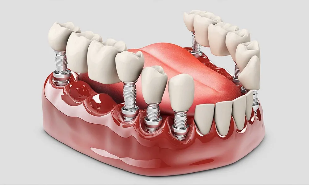 ایمپلنت دندان از صفر تا صد