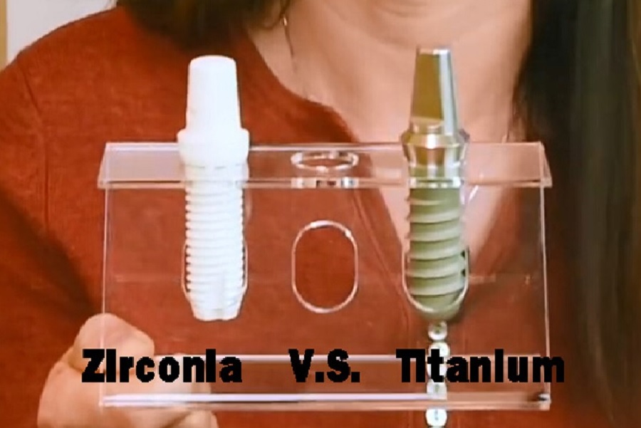 ایمپلنت تیتانیومی