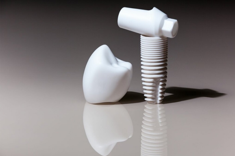 ایمپلنت تیتانیومی