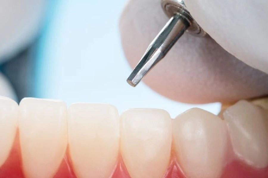 ایمپلنت دندان بدون پیوند استخوان

