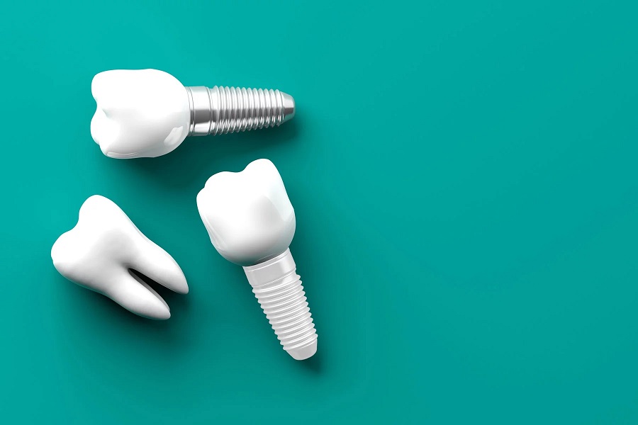 ایمپلنت تیتانیومی