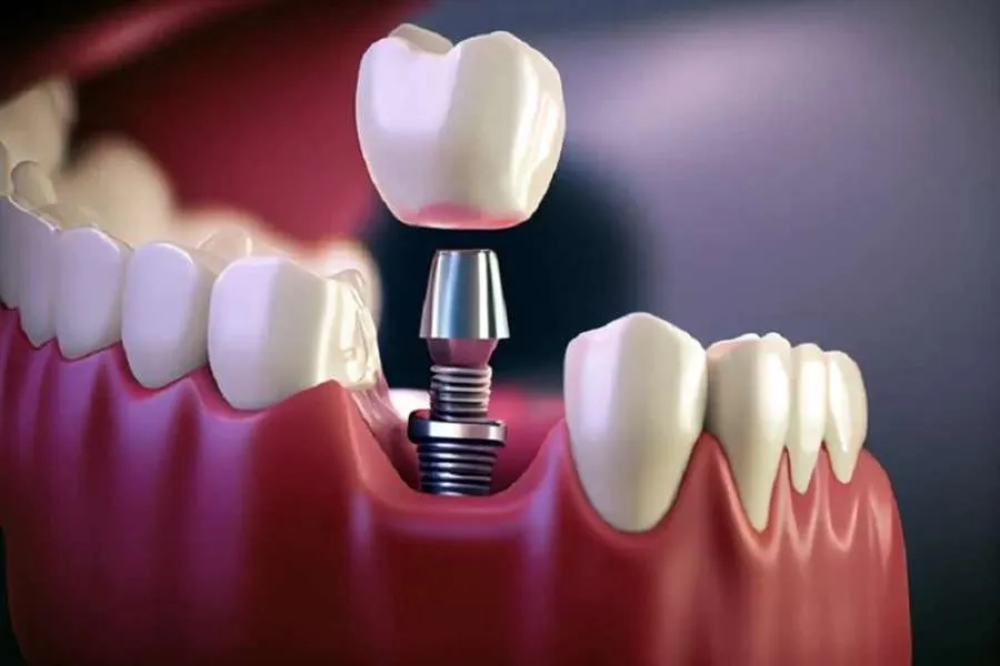 ماندگاری ایمپلنت دندان