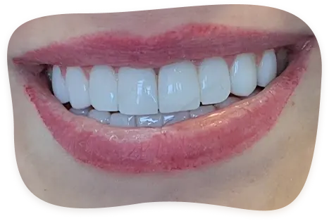 کامپوزیت دندان در لاهیجان