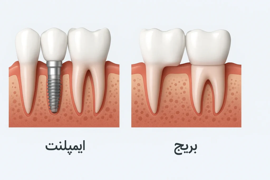 ایمپلنت یا بریج