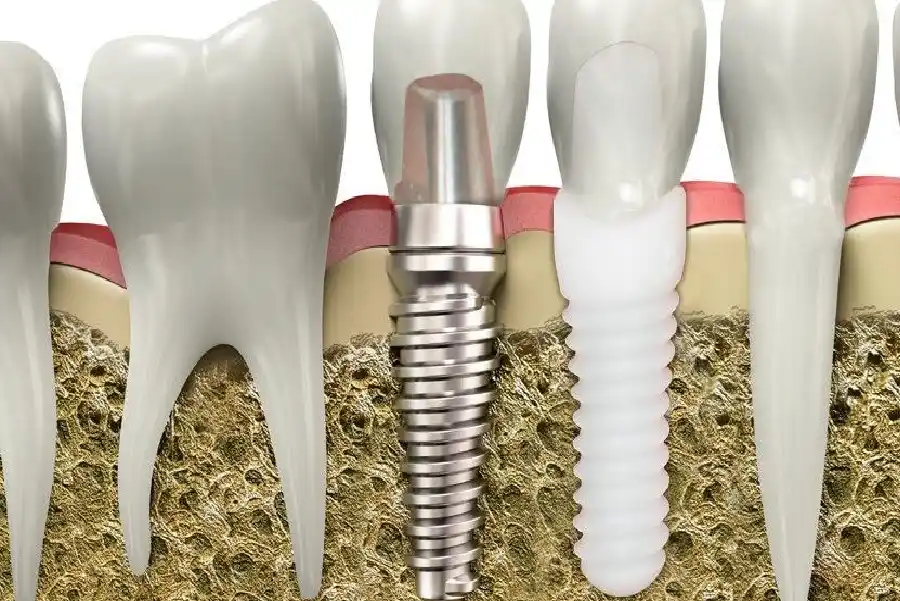 ایمپلنت تیتانیومی