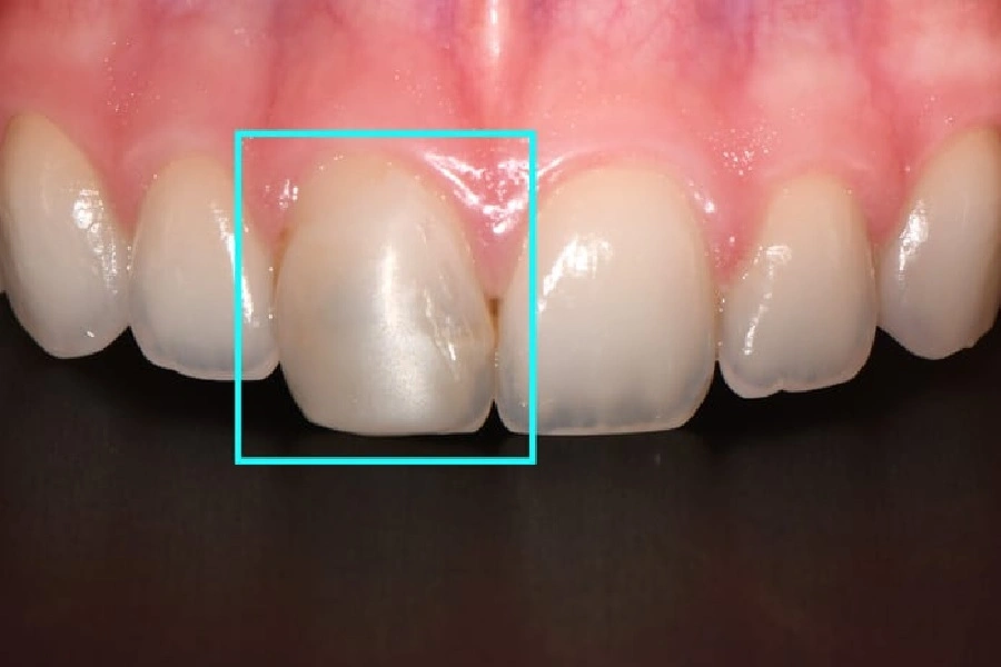 حساسیت دندان پس از کامپوزیت
