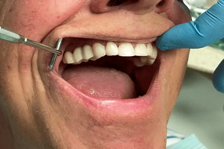 آیا ایمپلنت دندان درد دارد؟