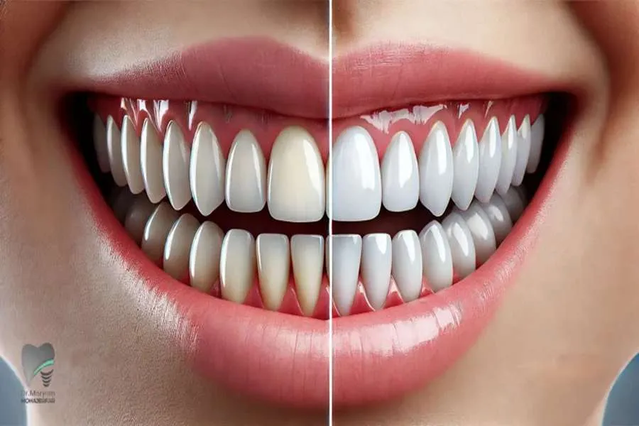 کامپوزیت برای فاصله دندان ها