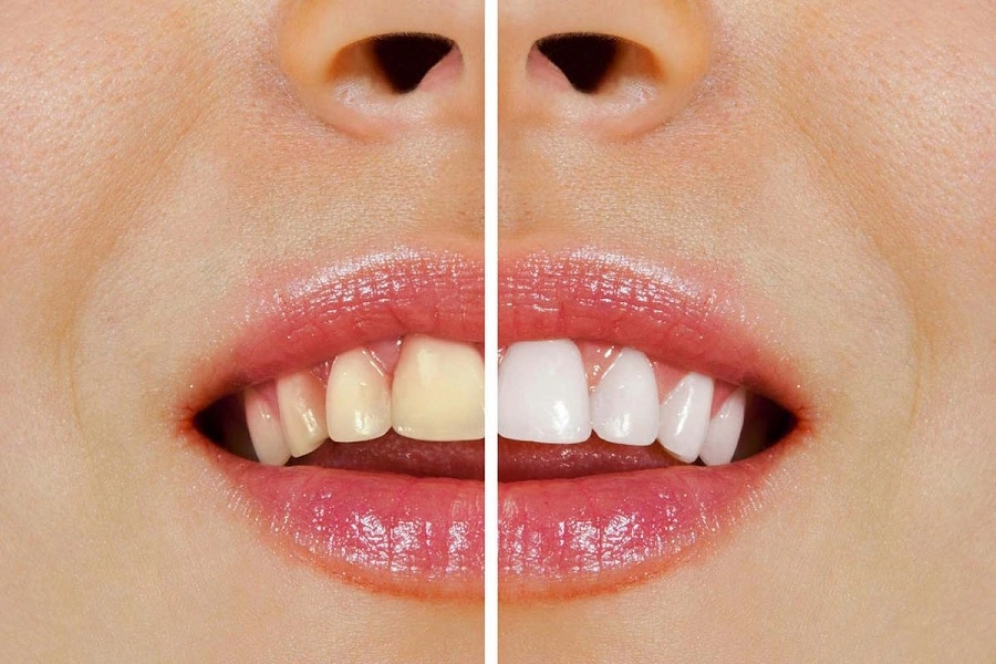 تغییر رنگ کامپوزیت دندان