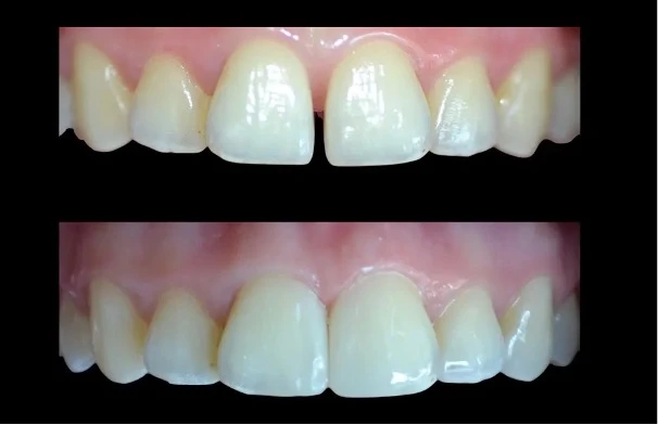 کامپوزیت برای فاصله دندان ها