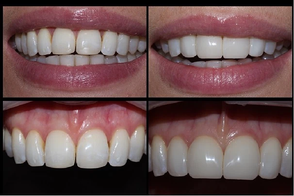 کامپوزیت برای فاصله دندان ها