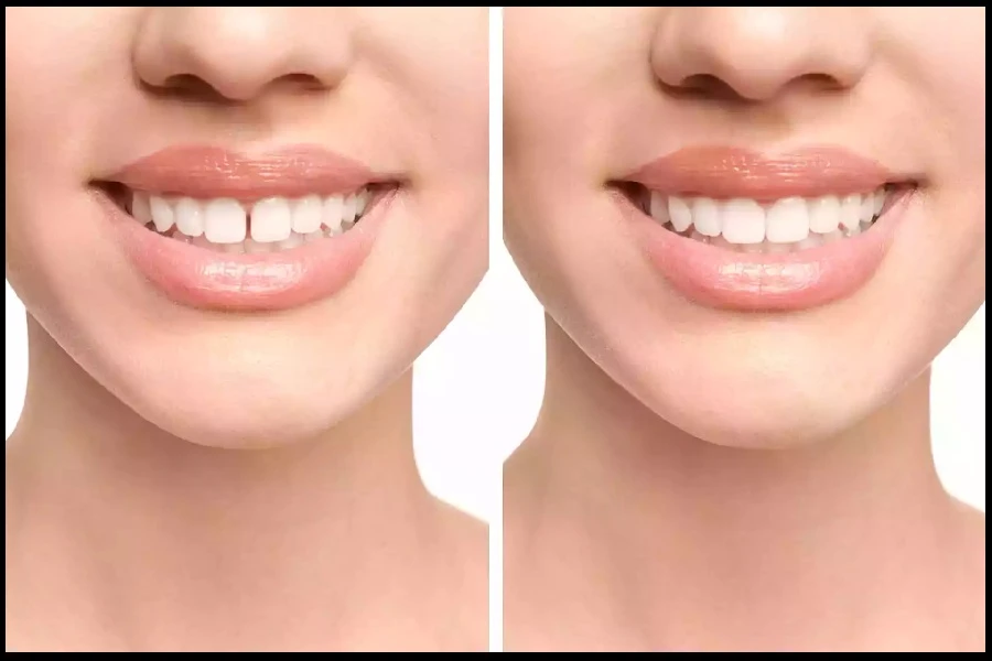 کامپوزیت برای فاصله دندان ها