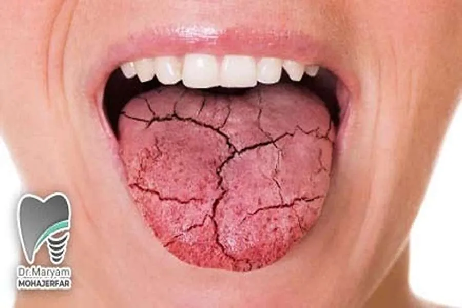 تاثیر خشکی دهان بر لمینت دندان