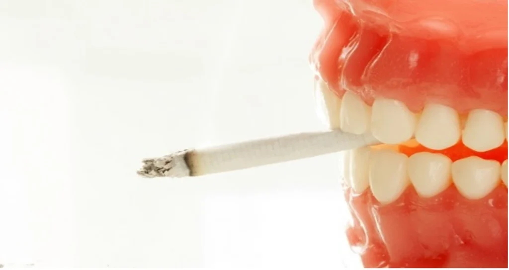 جلوگیری از تغییر رنگ لمینت دندان در افراد سیگاری