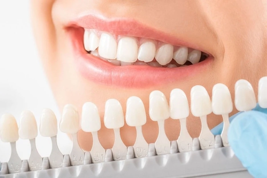 طول عمر لمینت دندان چقدر است؟