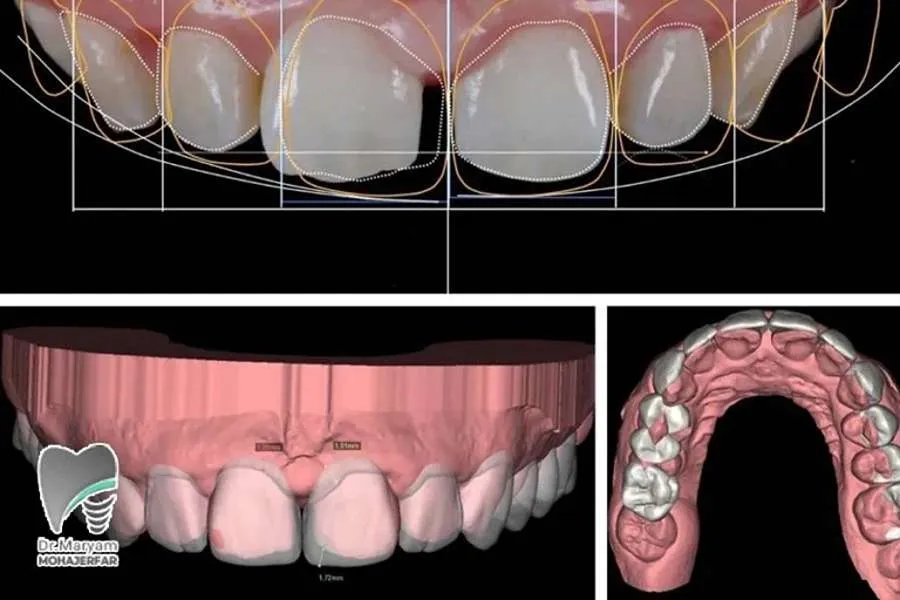 آنالیز لبخند دیجیتال