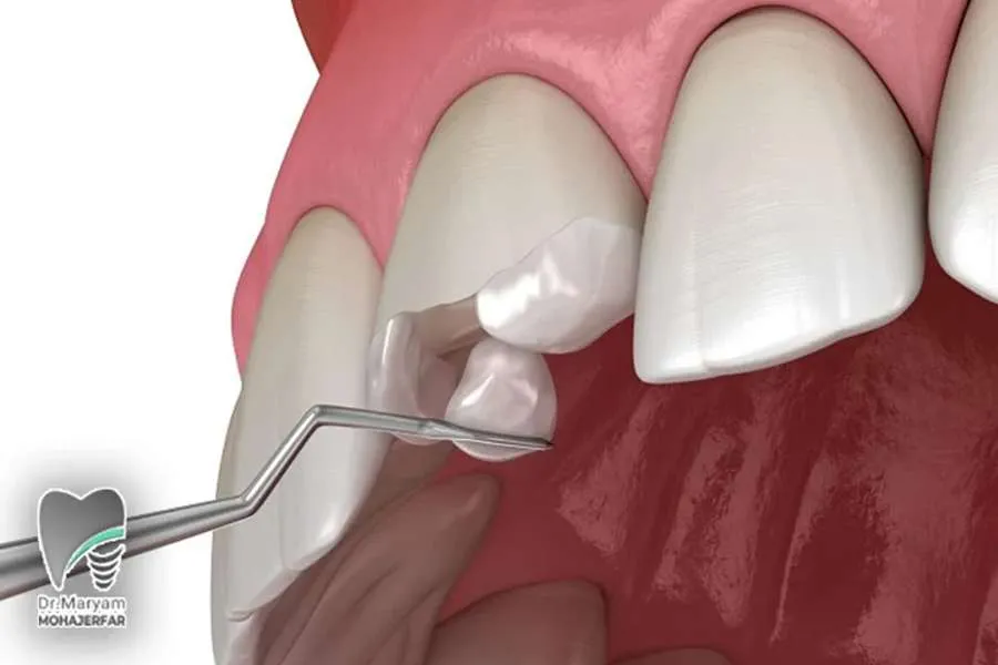 ماندگاری کامپوزیت ونیر