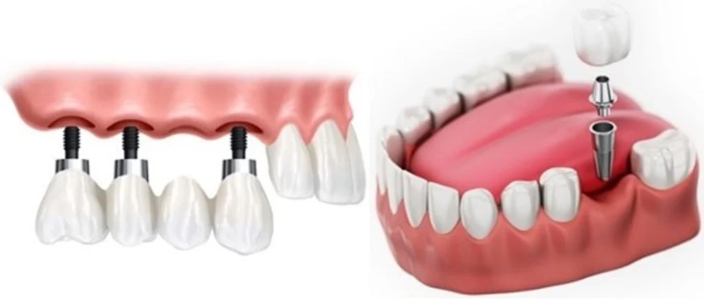 ایمپلنت دیجیتال