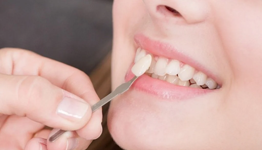 ماندگاری کامپوزیت ونیر