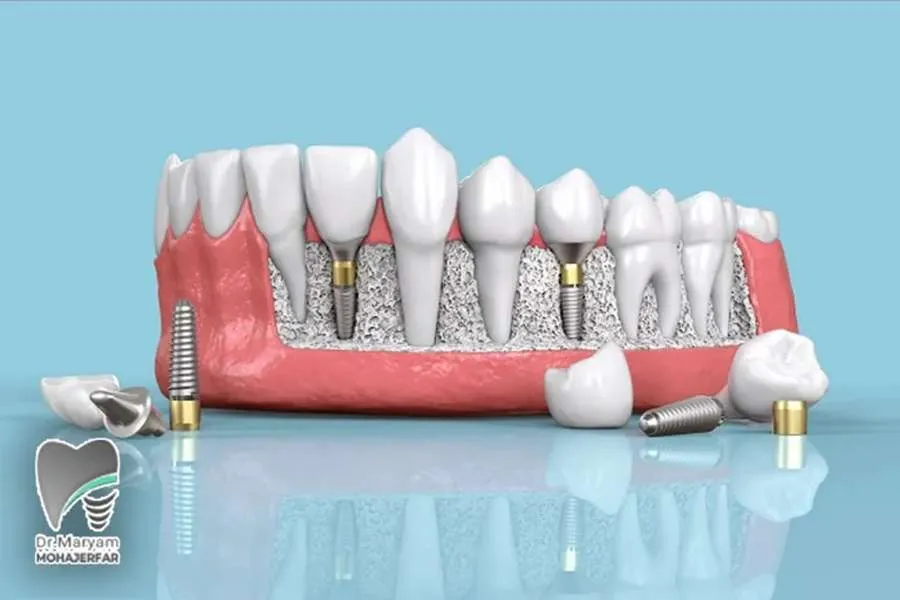 ایمپلنت دیجیتال