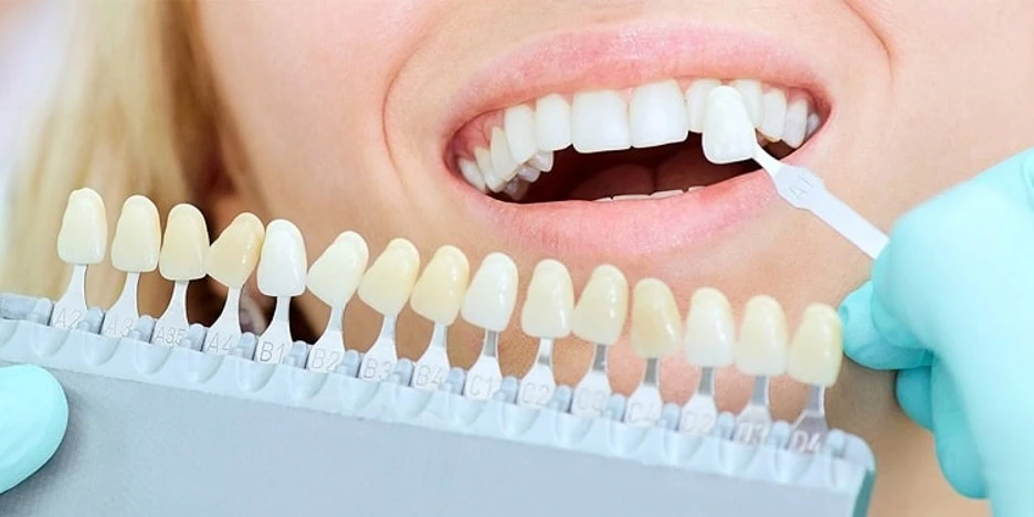 انتخاب رنگ کامپوزیت دندان