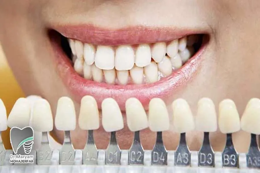 انتخاب رنگ کامپوزیت دندان