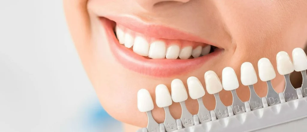 کامپوزیت دندان برای نوجوانان