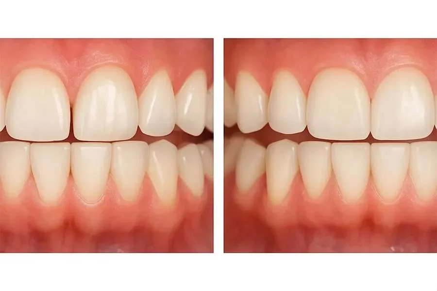 بستن فاصله دندانی با کامپوزیت