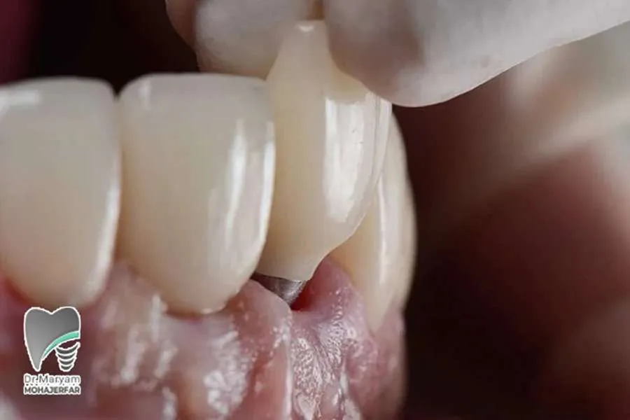 پس زدن ایمپلنت دندان