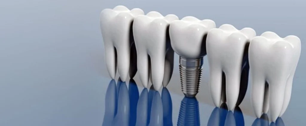 پس زدن ایمپلنت دندان