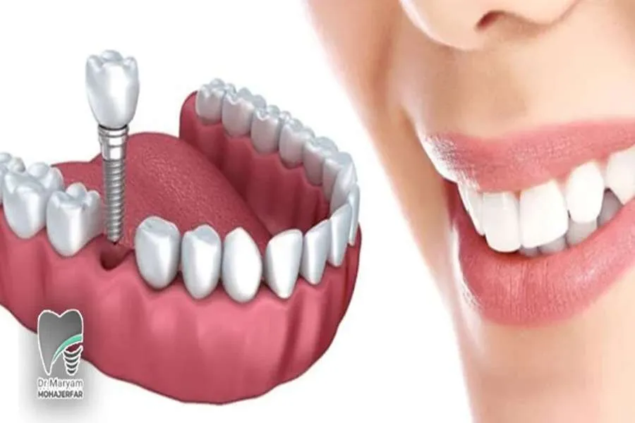 ایمپلنت فوری