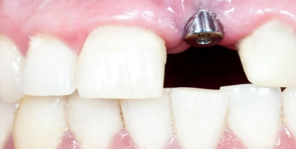 پس زدن ایمپلنت دندان