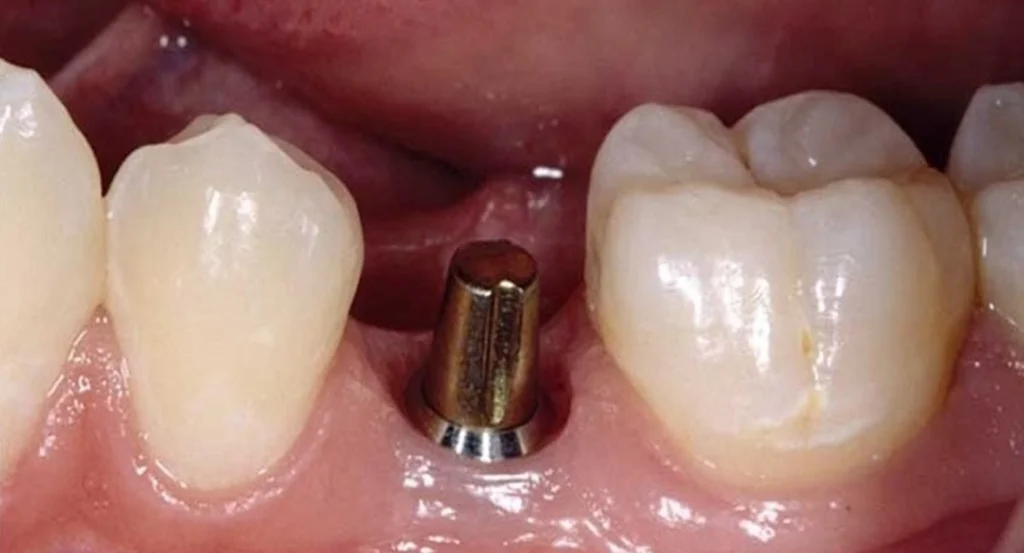 پس زدن ایمپلنت دندان