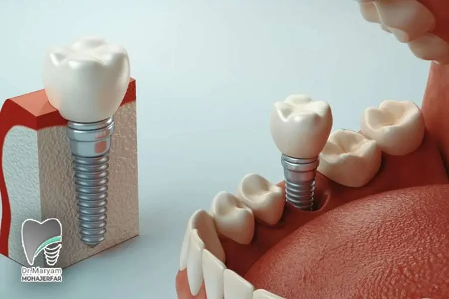 زمان مناسب برای ایمپلنت بعد از کشیدن دندان