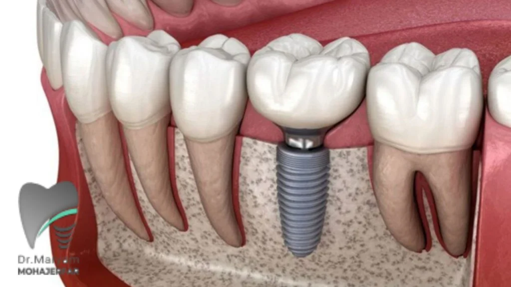آماده‌سازی فک برای ایمپلنت