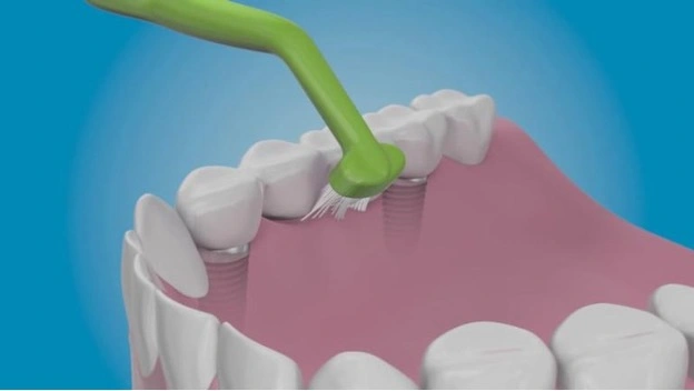 جرم‌گیری ایمپلنت دندان