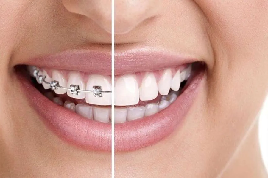 کامپوزیت دندان نامرتب