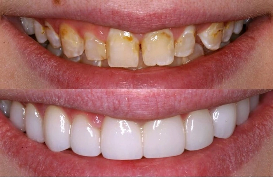 تغییر چهره بعد از کامپوزیت