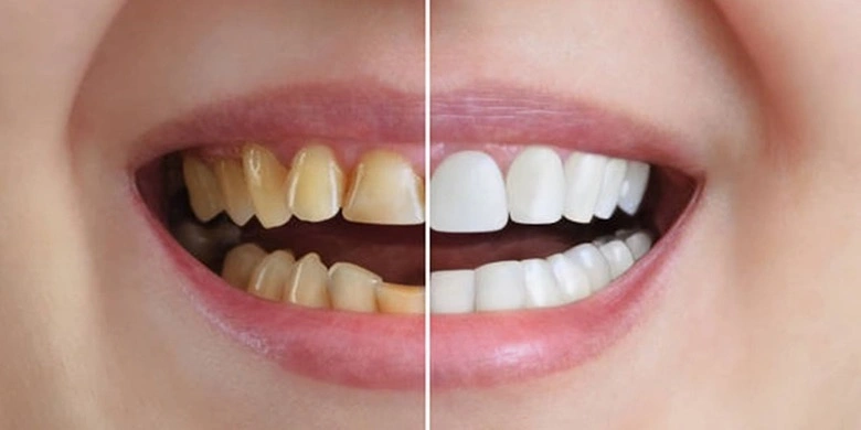 تغییر چهره بعد از کامپوزیت