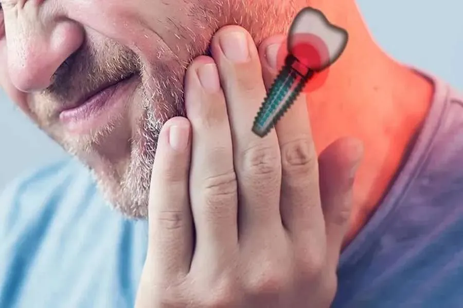 درد بعد از ایمپلنت