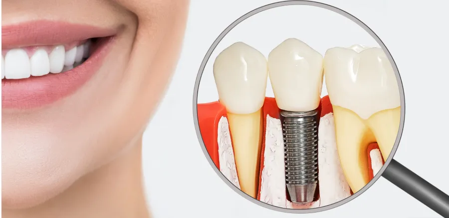 مراقبت از ایمپلنت دندان 