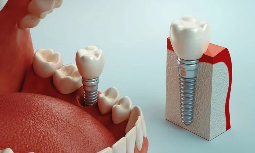مراحل درمان دندان تا ایمپلنت