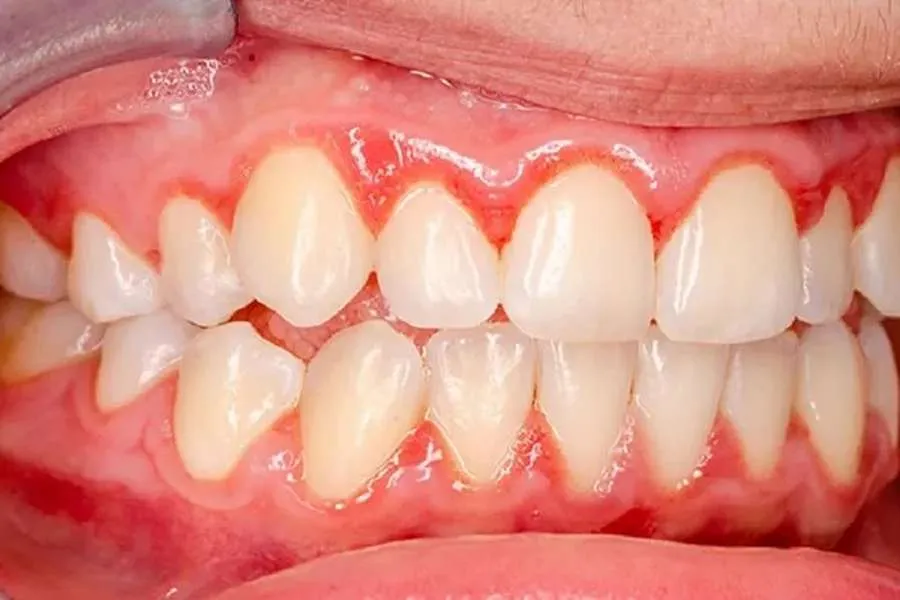 التهاب لثه بعد از لمینت