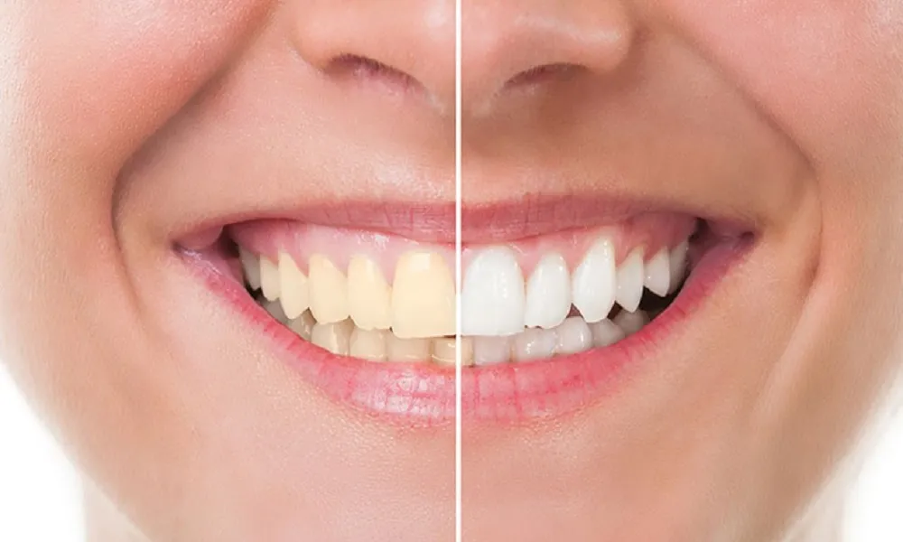 پولیش دندان